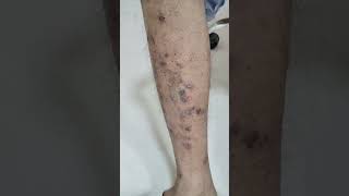 PRURIGO NODULARIS PN skincare dermatology disease healing viralvideo shorts disease [upl. by Oelgnaed]