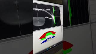 Topografia de Córnea [upl. by Bradan]
