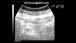 Epiploic appendagitis [upl. by Dewitt]