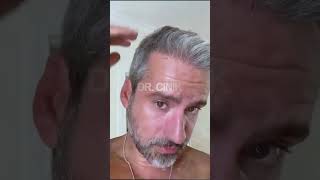 DrCinik Hair Transplant  FUE  3500 Grafts [upl. by Maite449]