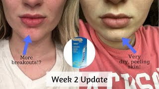 Differin Gel Retinoid Treatment  Week 2 Update [upl. by Drapehs]