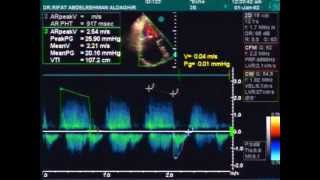 valvular heart disease [upl. by Hoang]