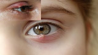 Chalazion Explained Causes Treatment Options and Easy Prevention Tips [upl. by Esahc]