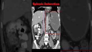 Splenic infarction  Cect Abdomen  Abdomen CT shorts radiology splenicinfrection [upl. by Ydnyc]