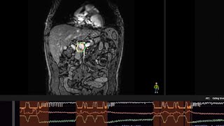 MRlinac Comprehensive Motion Mangement [upl. by Eelynnhoj]