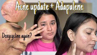 Why did i get acne back after 2 yrs of Tretinoin Acne update  Part 5 [upl. by Cousin]