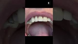 Коронки или Виниры Crowns vs Veneers smile dentalintes medical dental [upl. by Hogen]