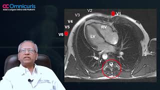 Dr C Narasimhan Speak On Bundle Branch Blocks amp Fascicular Blocks in ECG  Teaser [upl. by Anirtal]