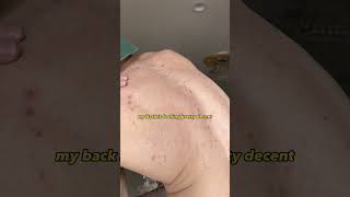 10 Days After Laser Hair Removal hairremoval [upl. by Kcira]