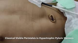 Visible Peristalsis in Pyloric Stenosis Classical Peristaltic Wave of Hypertrophic Pyloric Stenosis [upl. by Laohcin]