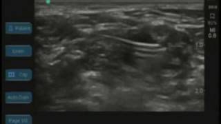 Ultrasound Guided Interscalene Catheter [upl. by Clothilde472]