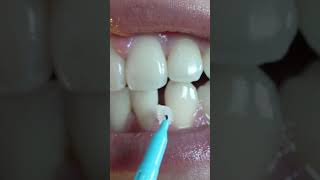 How to use interdental brushes [upl. by Mccutcheon]