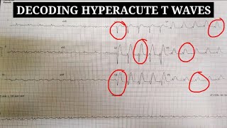 Hyperacute T waves in ECG  Learn to diagnose it and its immediate management [upl. by Elauqsap]