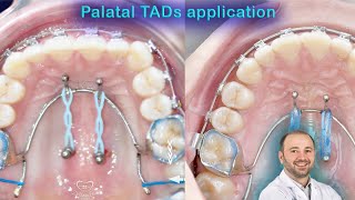 Wide range of palatal TADs applications mini screws palatelly benefits of mini implants in palate [upl. by Yrag]