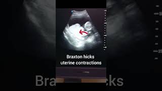 Braxton hicks contractionsmedicalimaging imaging ultrasound learning medicine viral doctor [upl. by Steffane]