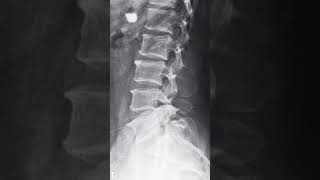 PARS INTERARTICULARIS FRACTURE [upl. by Inwat]