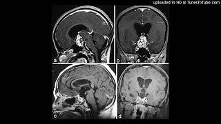 Resection of Retrochiasmatic Craniopharyngioma [upl. by Rida]