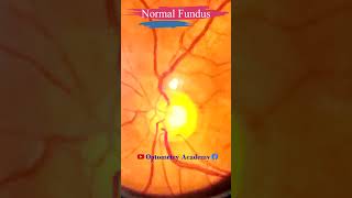 Normal fundus  Normal Retina  Smartphone Fundus Videography  Fundus Photography  Short Video 86 [upl. by Malamut175]