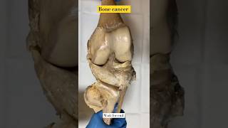 The Scary Truth About Bone Cancer ytshorts facts shorts [upl. by Lolita]