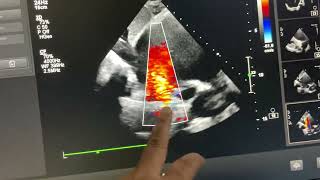 IVC type sinus Venosus ASD with partial anomalous pulmonary Venous connection ￼ [upl. by Madaih]