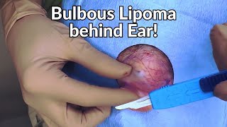 what the sigma dermatologist rizzles lipoma from behind the ear [upl. by Jules]