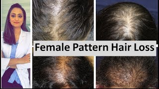 Hair loss in women  Female Pattern Hair Loss  causes amp treatment  Dermatologist [upl. by Ursala]