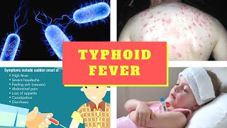 Typhoid Fever Symptoms – Causes Symptoms and Pictures of Enteric fever in Men women [upl. by Lorilyn803]