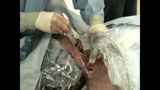 Placement of Central Venous Catheter  NEJM [upl. by Daniele]