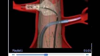 Zenith Fenestrated AAA Endovascular Graft [upl. by Kihtrak275]