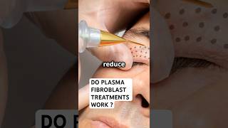 Do Plasma Fibroblast Treatments Work for Stretch Marks [upl. by Artur]