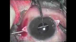 Scleral fixation IOL implantation [upl. by Notniv345]