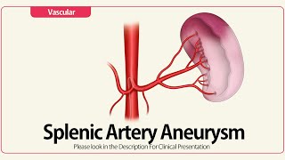 Saccular Splenic Artery Aneurysm [upl. by Asiil23]