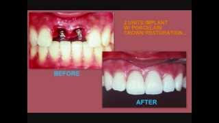 Dental Implantsaffordable at Angeles City Philippines 639209201549 [upl. by Noied]