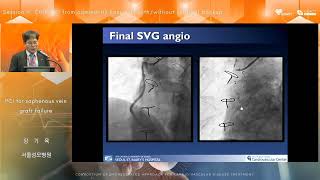 AUDITORIUM 2024 COACT CHIP WORKSHOP 43 PCI for saphenous vein graft failure 장기육 [upl. by Waldemar]