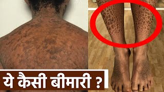 Ichthyosis vulgaris Disease क्या है Symptoms Reason Treatment । Boldsky Health [upl. by Anairol]