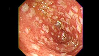 Gastric Intestinal Metaplasia  Chuyển sản ruột [upl. by Toor]