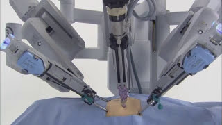 da Vinci® Robotic Surgical System [upl. by Menides844]