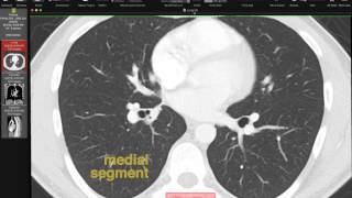 Lobar and Segmental Lung Anatomy on CT [upl. by Anelis]