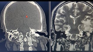 Ear Infection 👂 Leading into BRAIN infection 🧠 Radiology ent skull neurosurgeon [upl. by Ramor90]