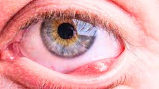 What is Chalazion Causes Symptoms Treatment [upl. by Yaya]