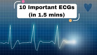 10 Important ECGs in 15 mins cardiology ecg ekg [upl. by Burrow]