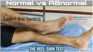 Heel to Shin TEST coordinationtest Normal Abnormal assessment procedure cerebellum neurology [upl. by Stryker]