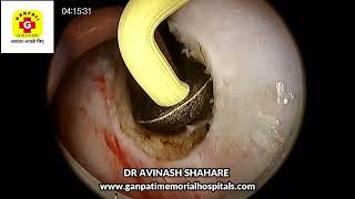 BIPOLAR TUVP amp TURP PROSTATE RESECTION FOR PROSTATIC HYPERTROPHY DR AVINASSH SHAHARE SHALYA TUROSEAL [upl. by Burford]