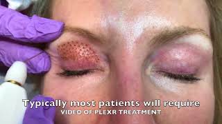 PLEXR PLASMA Eyelid Blepharoplasty [upl. by Aztin]