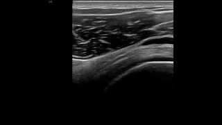 Subacromialsubdeltoid bursa ultrasound [upl. by Nosidda]