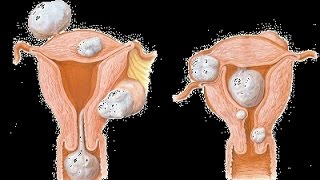 FIBROMATOSIS UTERINA [upl. by Wrand]