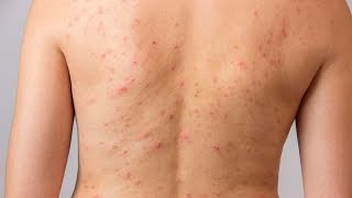 Acne in the back and chest causes and natural treatments [upl. by Hanleigh]