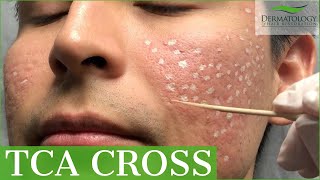 Acne Scar Removal with TCA Cross 80  Los Angeles  Dr Ben Behnam [upl. by Lledyr313]