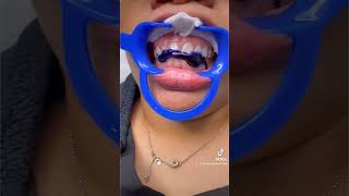 Does Purple Toothpaste Actually Work LaserGlow Toothpaste Review purpletoothpaste teethwhitening [upl. by Gerita]