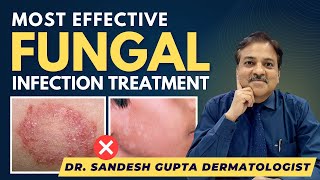 Effective Fungal Infection Treatment By Dermatologist  Dr SANDESH GUPTA 9990804089 [upl. by Nairdna936]